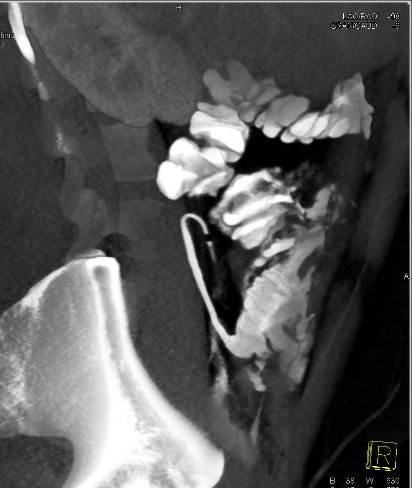 Retrocecal Appendix - CTisus CT Scan