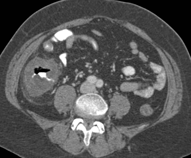 Ischemic Colitis Involves the Cecum - CTisus CT Scan