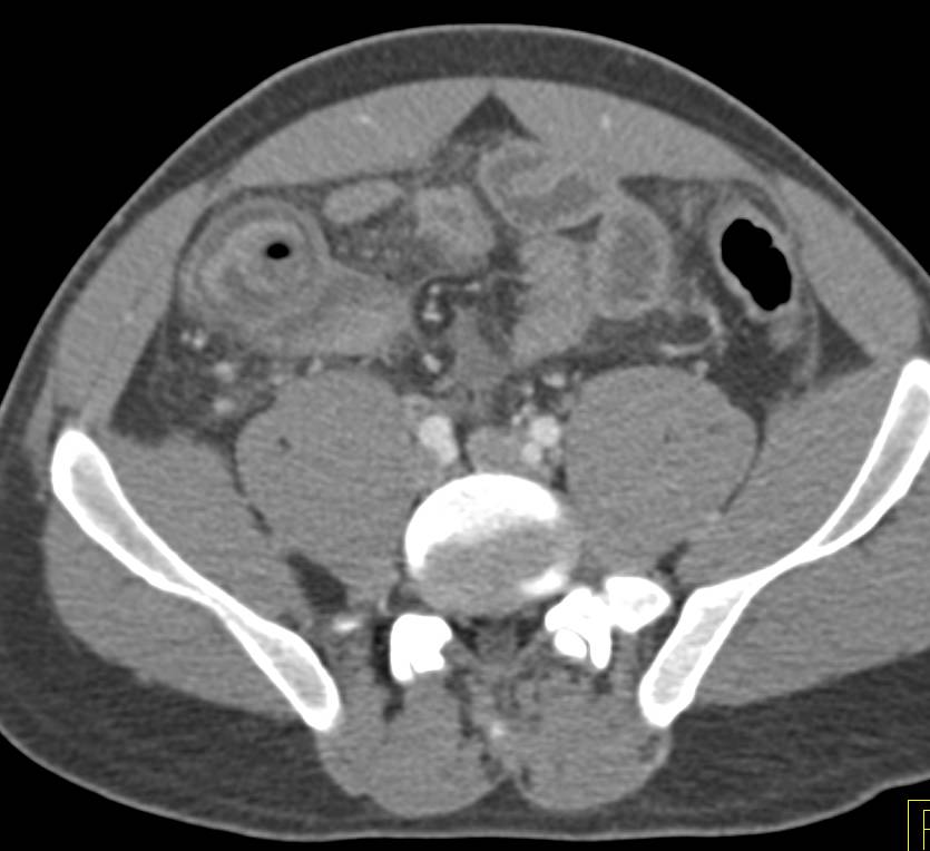 Appendicitis with Dilated Inflamed Appendix - CTisus CT Scan