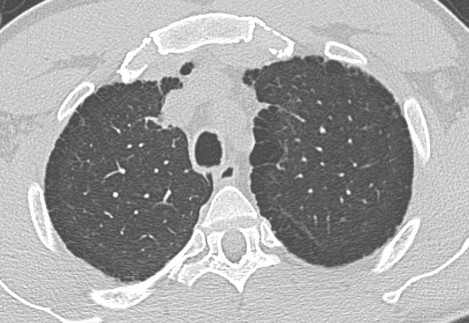 Appendicitis with Dilated Inflamed Appendix in a patient Whose Initial Complaint was Shortness of Breath Which was due to COPD - CTisus CT Scan