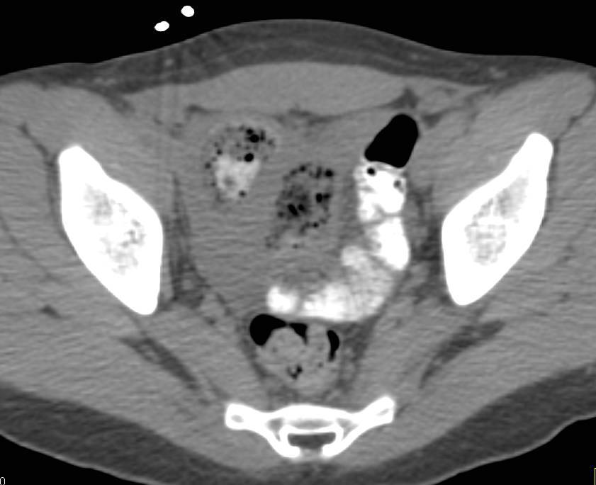 Right Lower Quadrant Abscess due to Missed Appendicitis - CTisus CT Scan