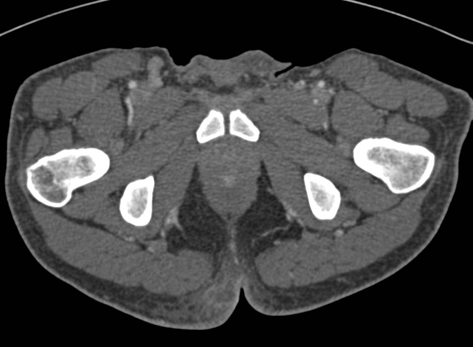 Perianal Abscess - CTisus CT Scan