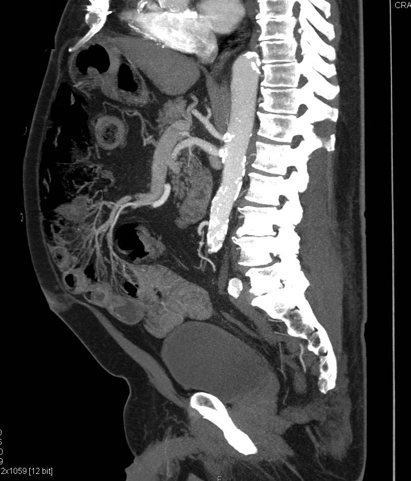 Extensive Pneumatosis Coli with Normal Physical Exam and no Evidence of Lactic Acidosis - CTisus CT Scan