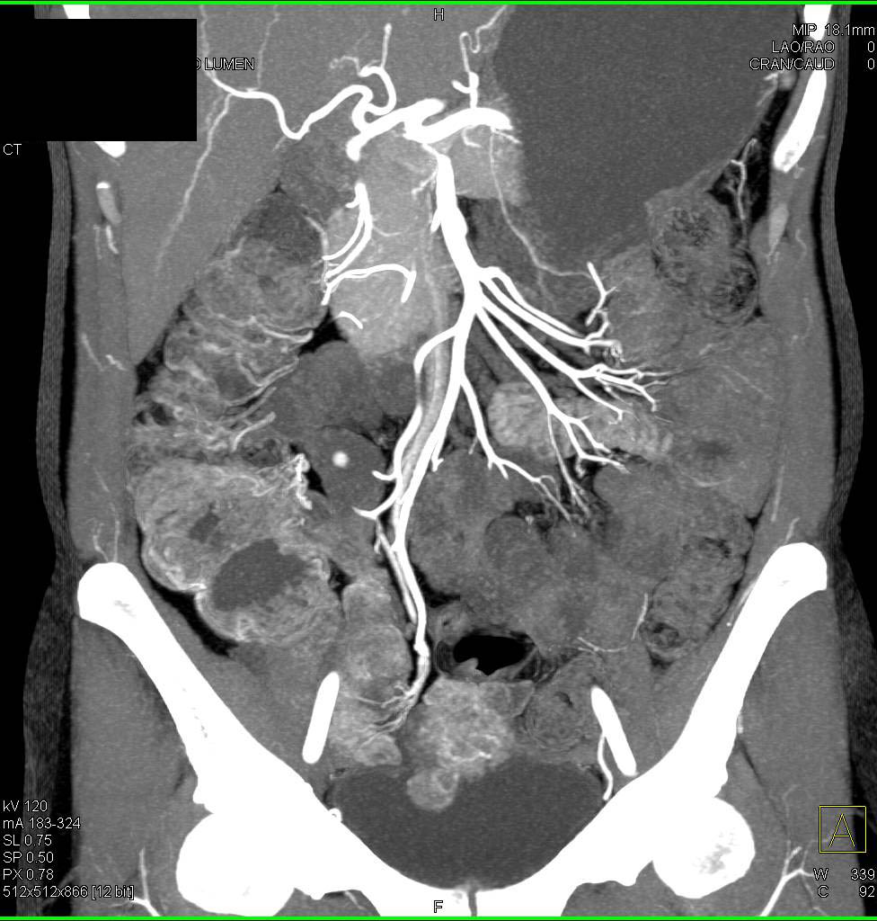 CTA Crohn's Disease with Prominent Enhancement of the Cecum - CTisus CT Scan