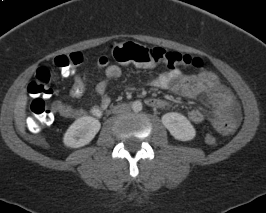 Colitis - CTisus CT Scan