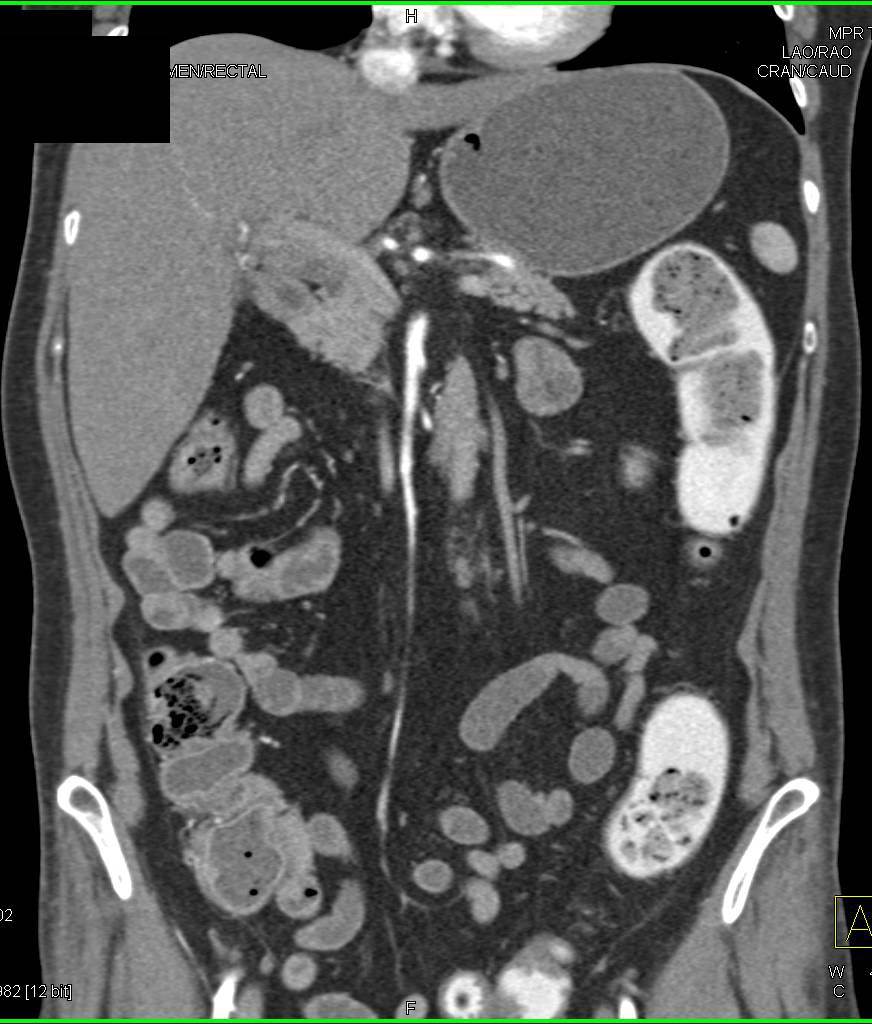 Rectal Contrast Without Perforation Defined - CTisus CT Scan