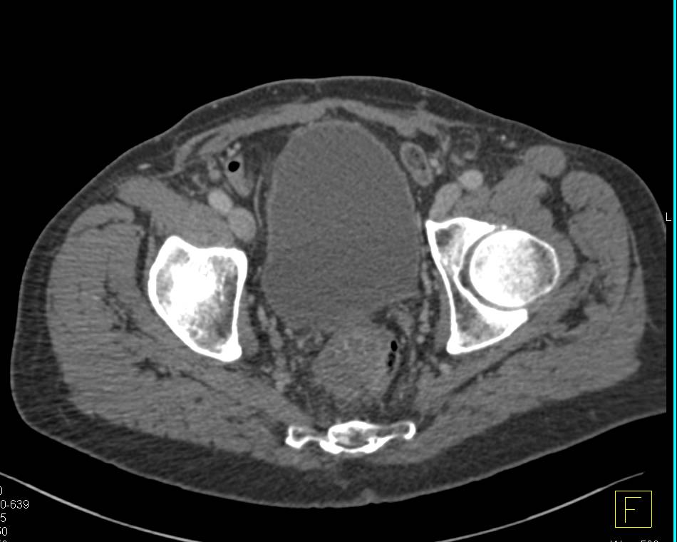 Invasive Rectal Carcinoma into Perirectal Space - CTisus CT Scan