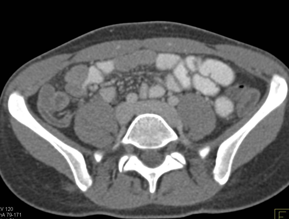 Acute Appendicitis - CTisus CT Scan