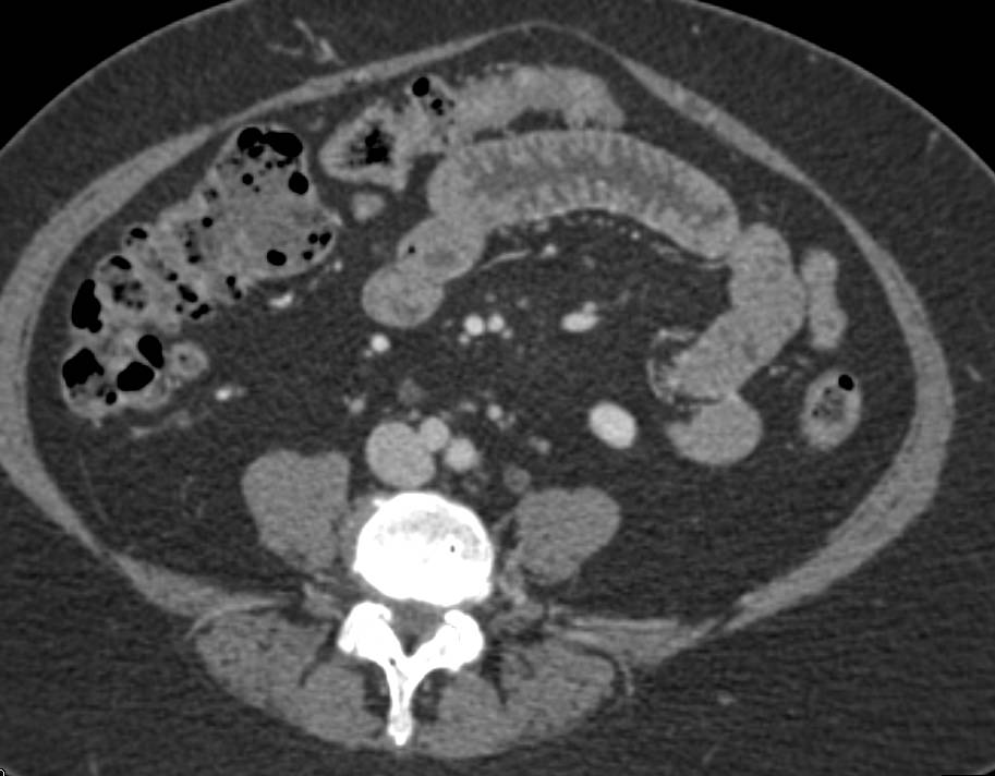 Ulcerative Colitis with Mesenteric Adenopathy - CTisus CT Scan