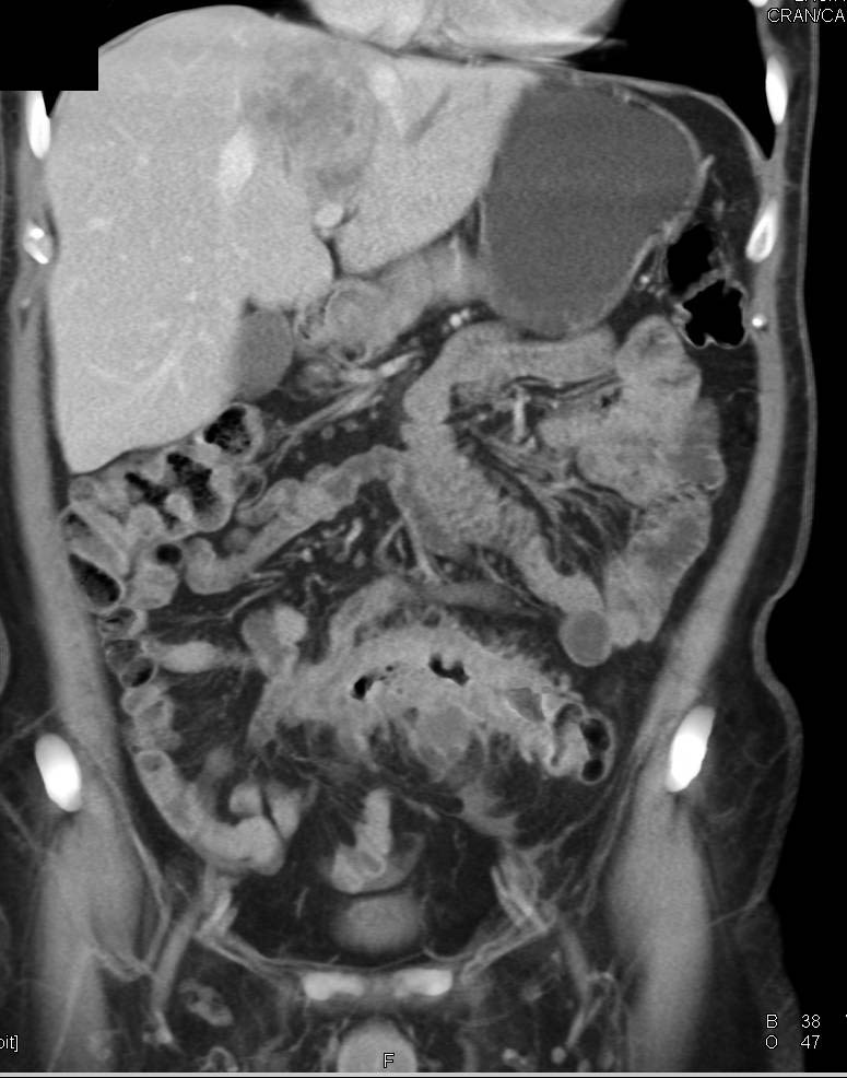 Sigmoid Colon Cancer Obstructs the Left Ureter - CTisus CT Scan