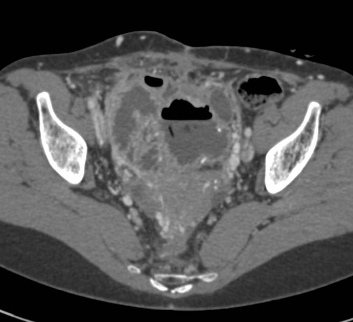 Recurrent Colon Cancer - CTisus CT Scan