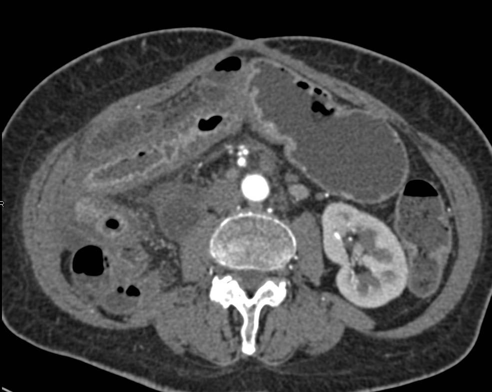 Ulcerative Colitis - CTisus CT Scan