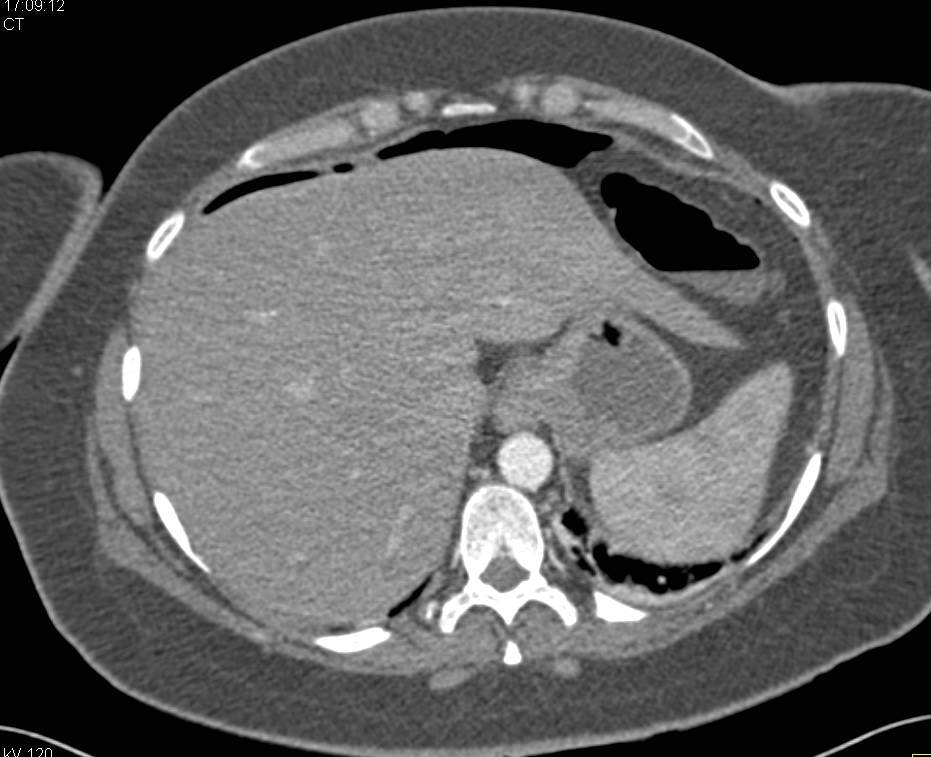 Pneumoperitoneum with Perforated Sigmoid Colon - CTisus CT Scan