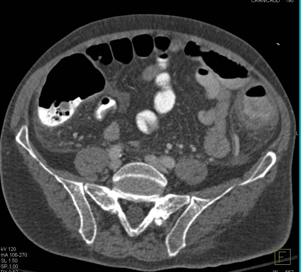 Pseudomembranous Colitis (PMC) of the Colon - CTisus CT Scan