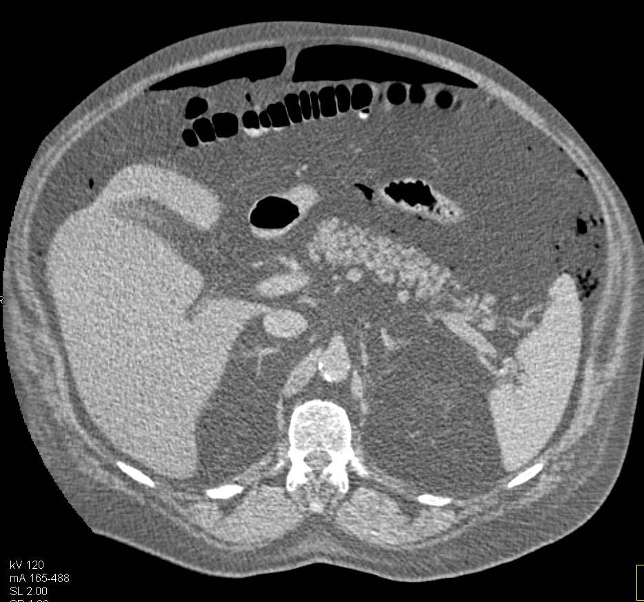 Pneumoperitoneum due to Diverticulitis - CTisus CT Scan