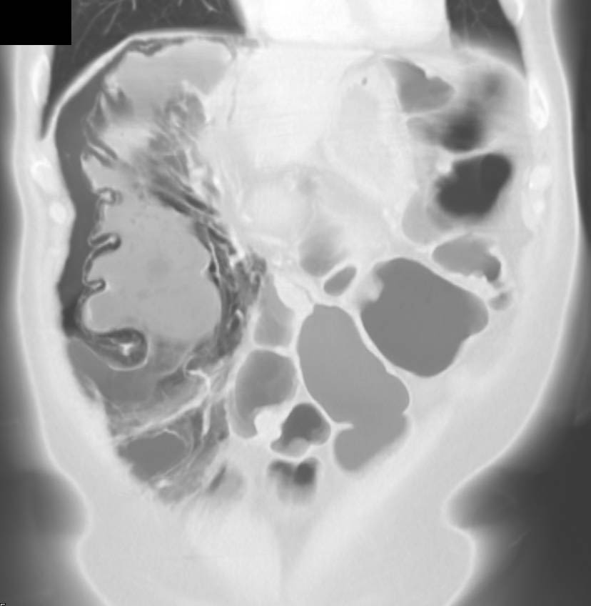 Impressive Pneumatosis Coli in 3D - CTisus CT Scan