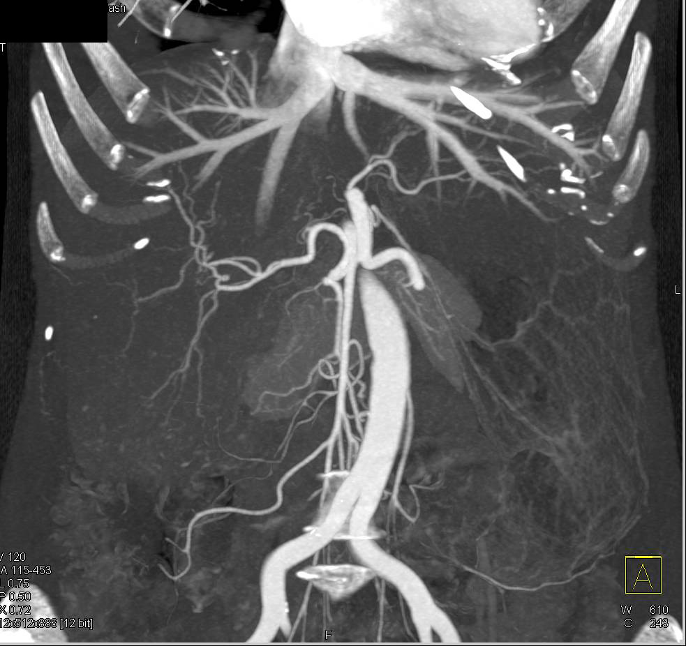 Ulcerative Colitis best seen in Transverse Colon - CTisus CT Scan