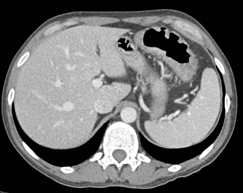 Ulcerative Colitis best seen in Descending Colon - CTisus CT Scan