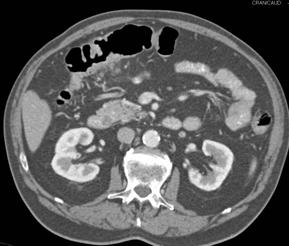 Carcinoma in Proximal Transverse Colon - CTisus CT Scan