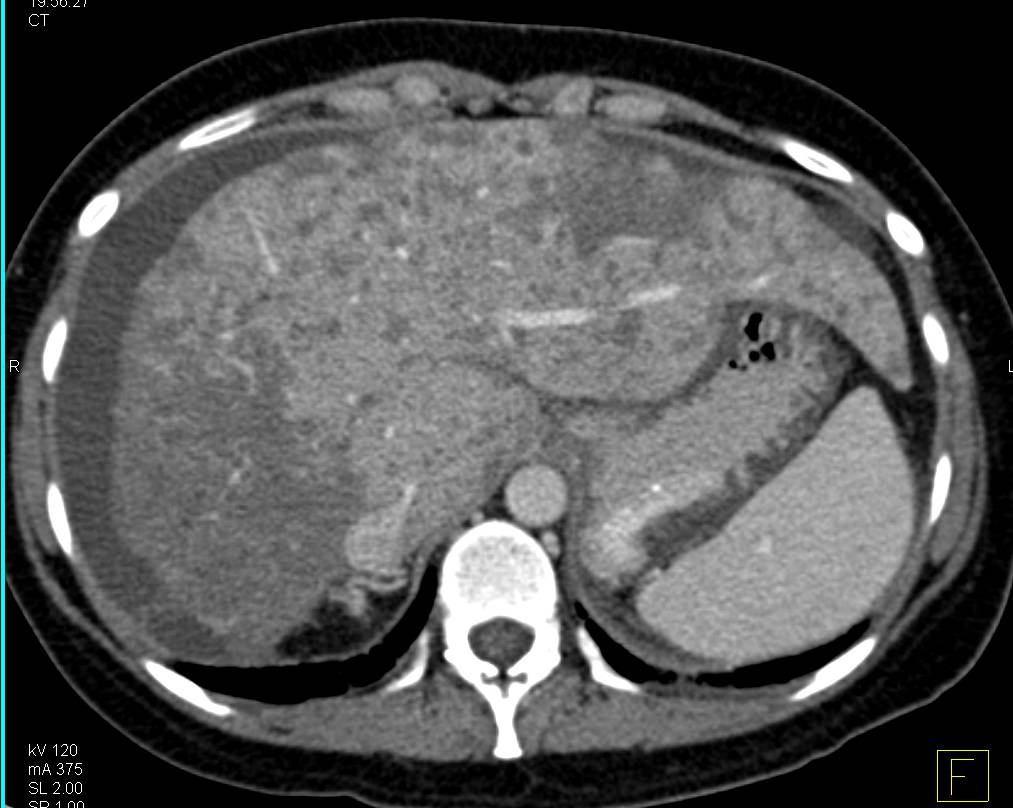 Pseudomembranous Colitis with Fatty Infiltration of the Liver - CTisus CT Scan