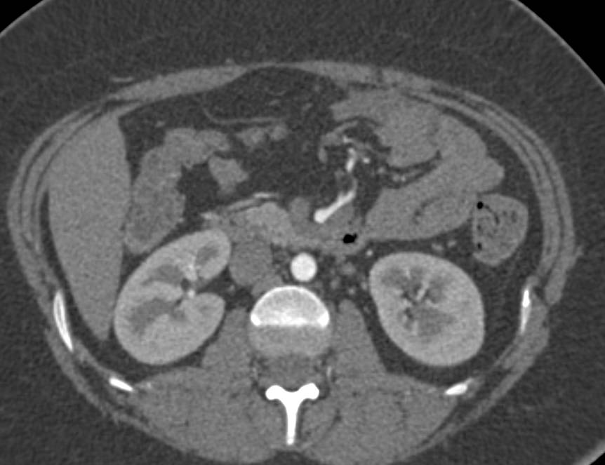 Ulcerative Colitis best seen in Ascending Colon - CTisus CT Scan