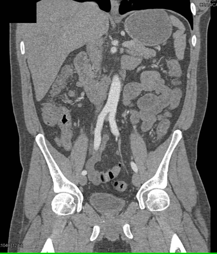 Ulcerative Colitis best seen in Ascending Colon - CTisus CT Scan