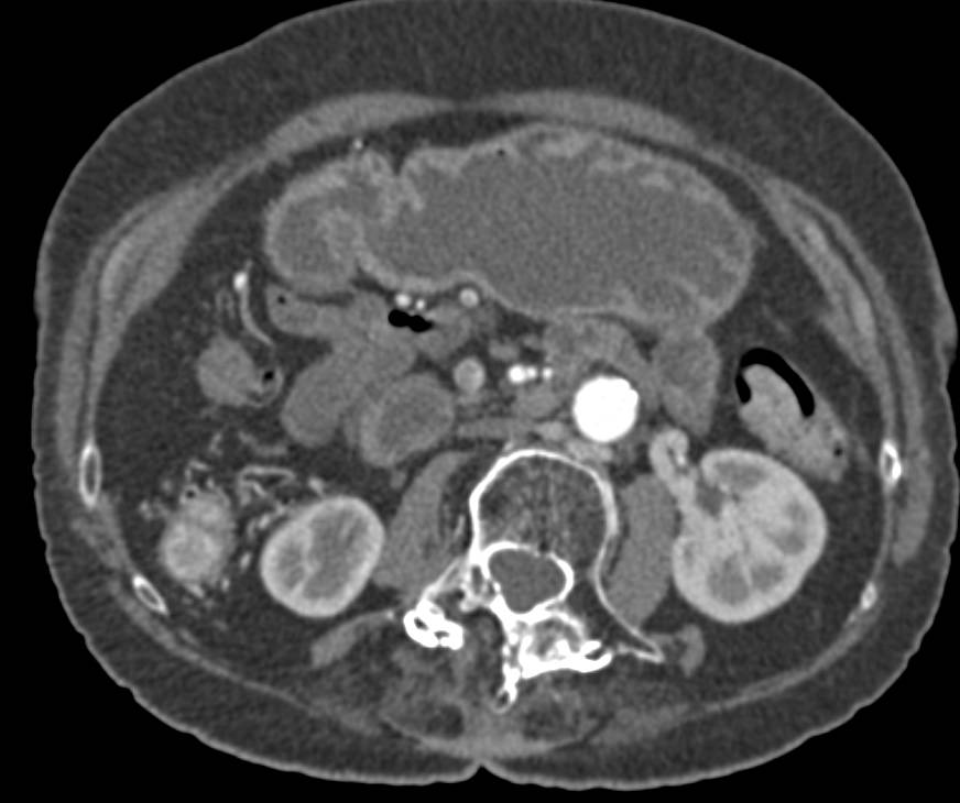 Colitis with Stricture in the Ascending Colon - CTisus CT Scan