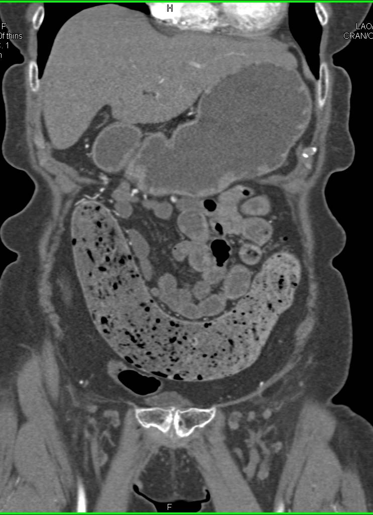 Colitis Involves Ileum and Ascending Colon c/w Crohn's Disease - CTisus CT Scan