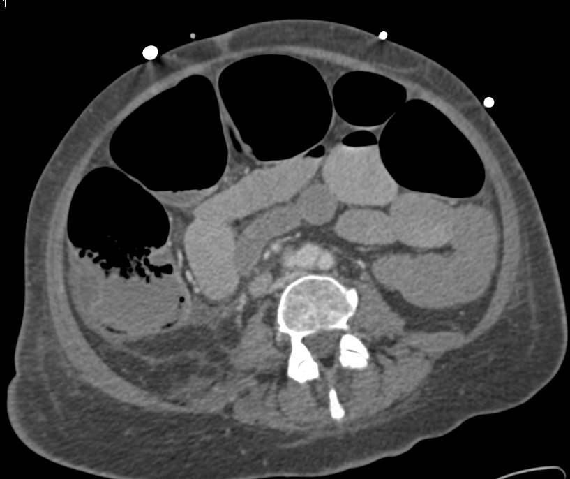 Vasculitis with Pneumatosis of the Right Colon and Ischemic Bowel - CTisus CT Scan