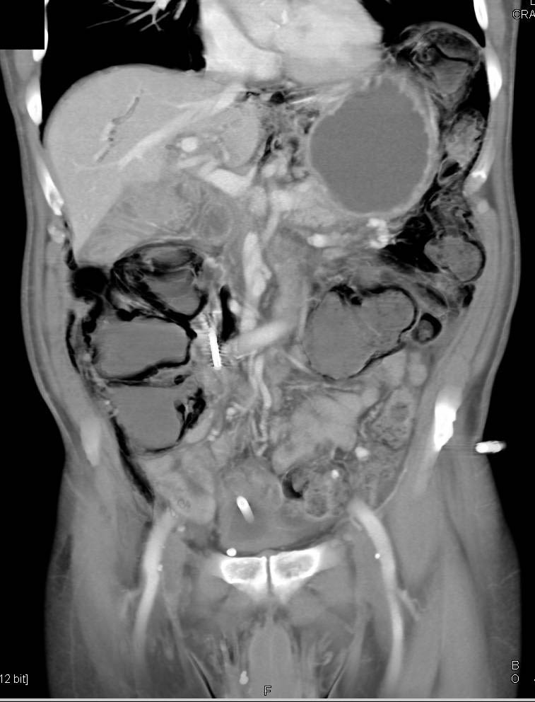 Ischemic Bowel with Pneumatosis and Portal Venous Air - CTisus CT Scan