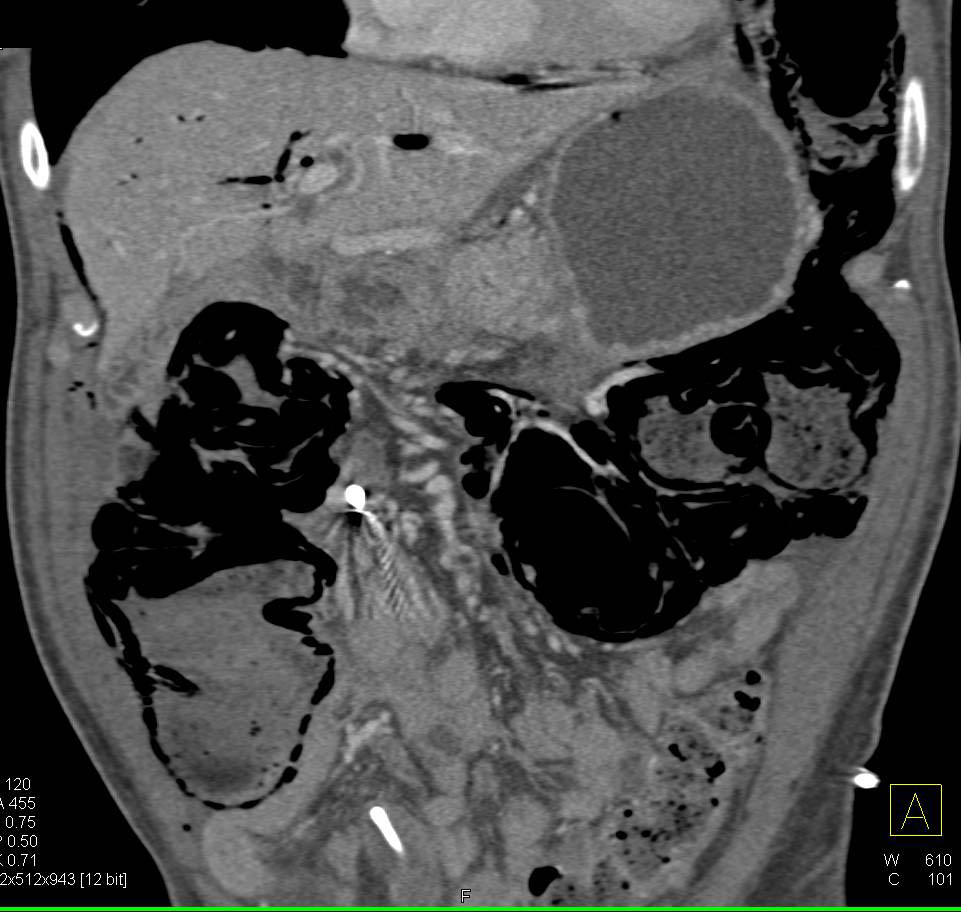 Ischemic Bowel with Portal Venous Air and Pneumatosis of the Colon - CTisus CT Scan