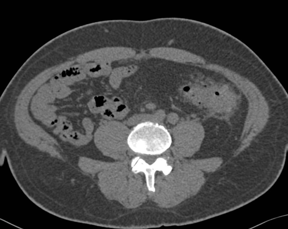 Diverticulitis with Colovesical Fistulae - CTisus CT Scan