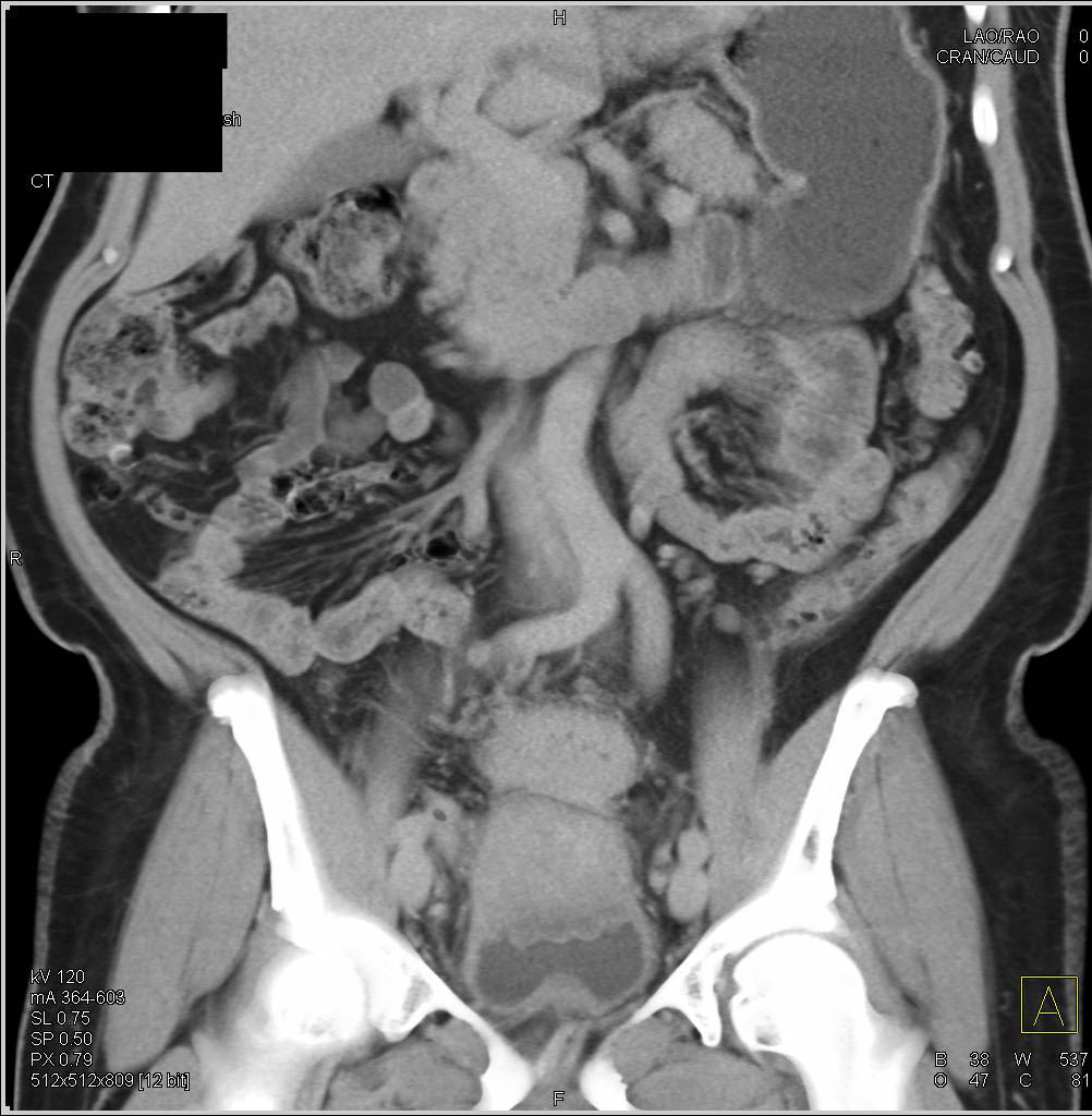 Diverticulitis with Colovesical Fistulae - CTisus CT Scan