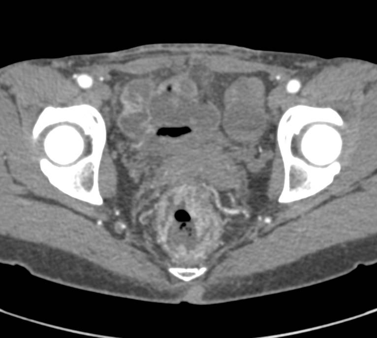 Rectal Cancer with Increased Vascularity of the Tumor in 3D - CTisus CT Scan