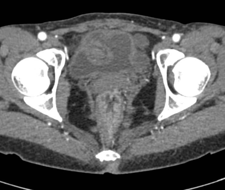 Rectal Varices with Gastrointestinal (GI) Bleeding - CTisus CT Scan