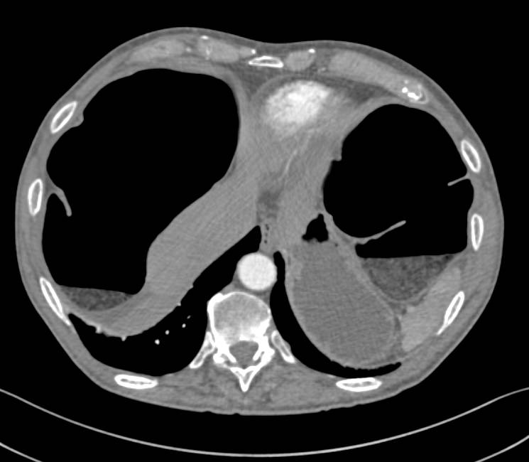 Sigmoid Volvulus - Colon Case Studies - CTisus CT Scanning