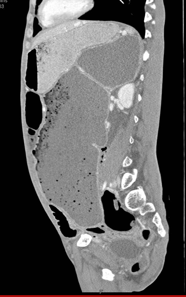 Sigmoid Volvulus - CTisus CT Scan