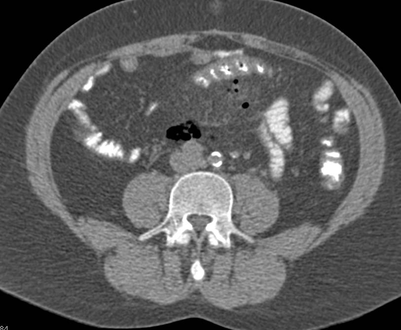 Diverticulitis with Perforation - CTisus CT Scan