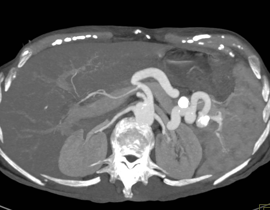 Ulcerative Colitis with a Stricture in the Rectum - CTisus CT Scan