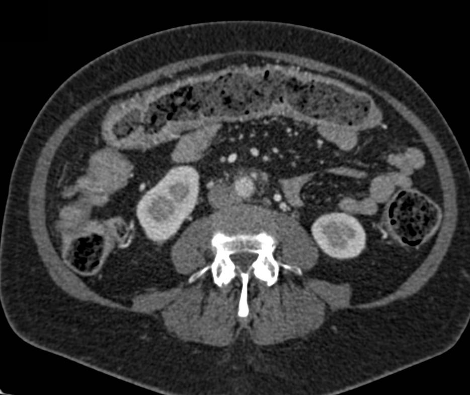 Ulcerative Colitis with Edematous Transverse Colon - CTisus CT Scan