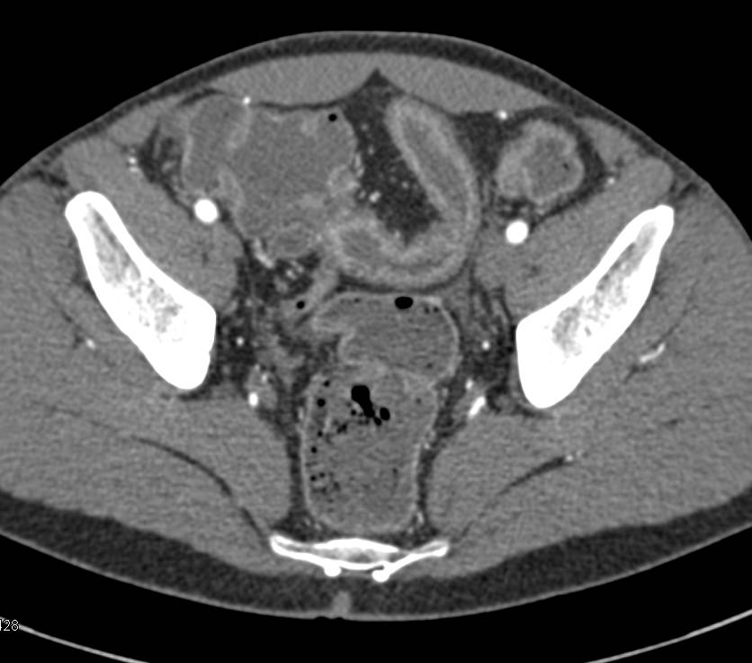 Crohn's Disease with Enhancing Ascending Colon and Abnormal Fold Pattern - CTisus CT Scan