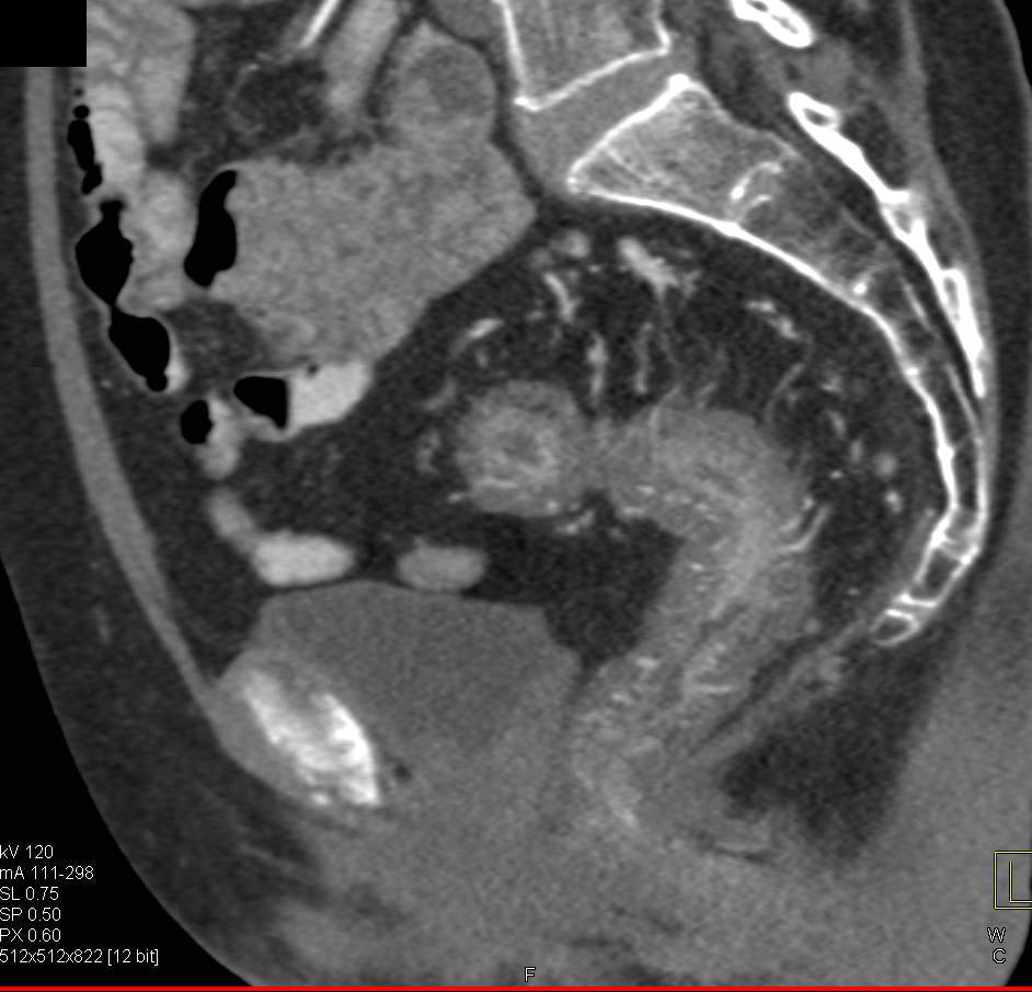 Rectal Bleed due to Ulcerative Colitis Well Shown with CTA - CTisus CT Scan