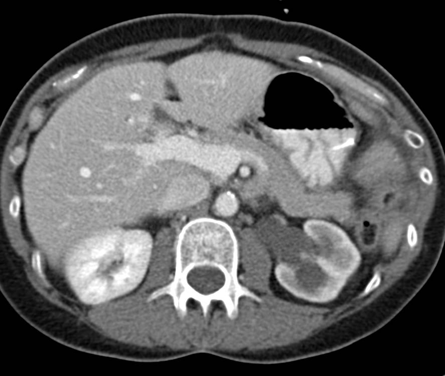 Rectal Cancer Invades the Bladder and Causes Left Hydronephrosis - CTisus CT Scan