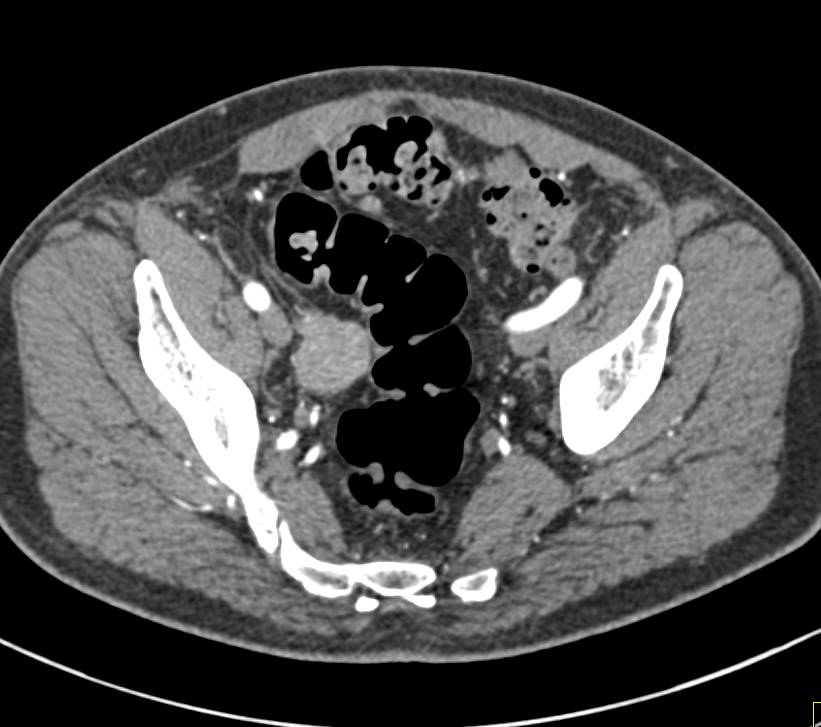 Pelvic Adenocarcinoma Adjacent to the Sigmoid Colon - CTisus CT Scan