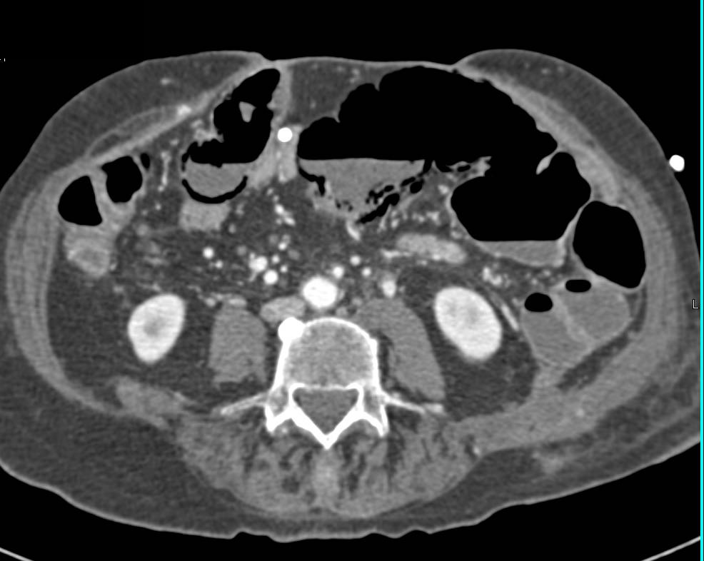 Large Bowel Pneumatosis - CTisus CT Scan