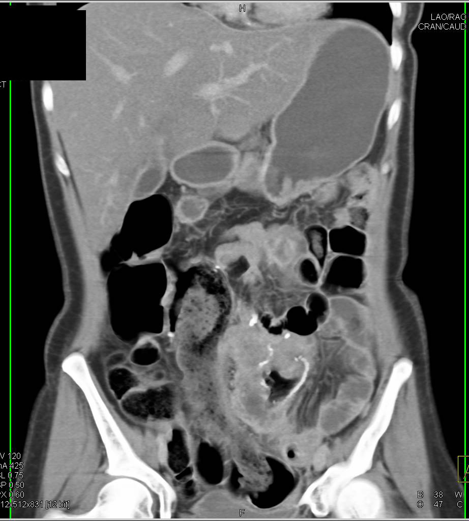 Local Recurrence of Colon Cancer - CTisus CT Scan