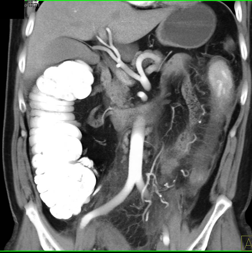 Ischemic Colitis Left Colon - CTisus CT Scan