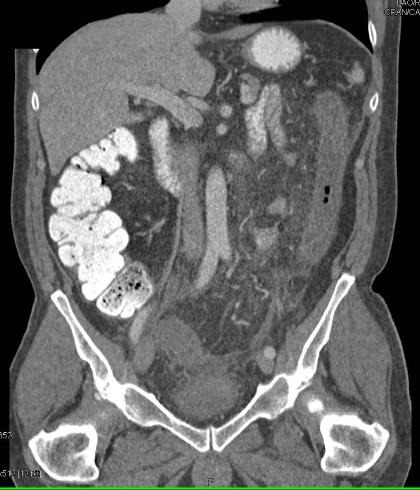 Ischemic Colitis Left Colon - CTisus CT Scan