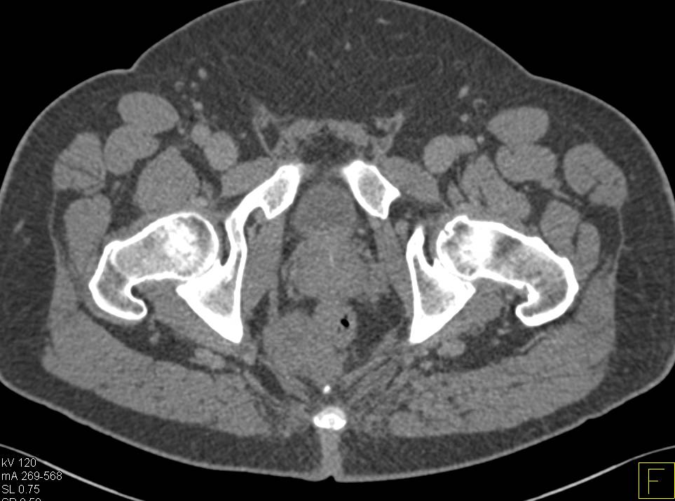 Perirectal Mass was a Neurogenic Tumor - CTisus CT Scan