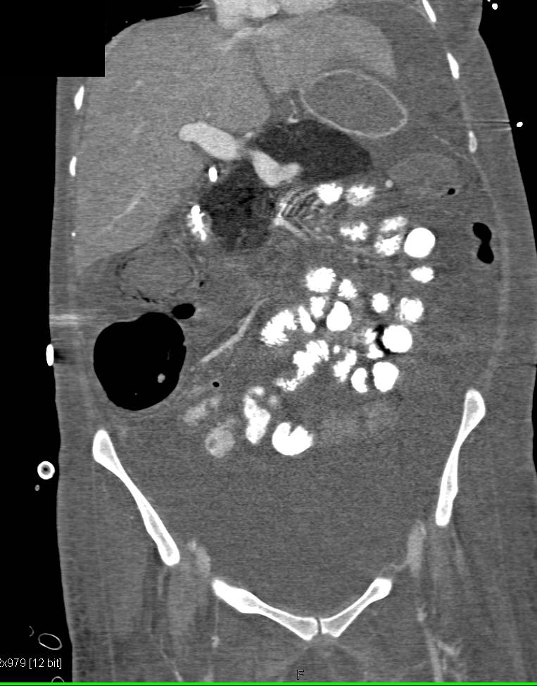 Ischemic Bowel with Ascites and Pneumoperitoneum - CTisus CT Scan